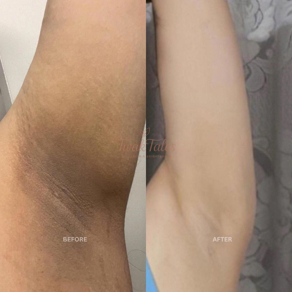 Eliza Helena Before and After Result 1